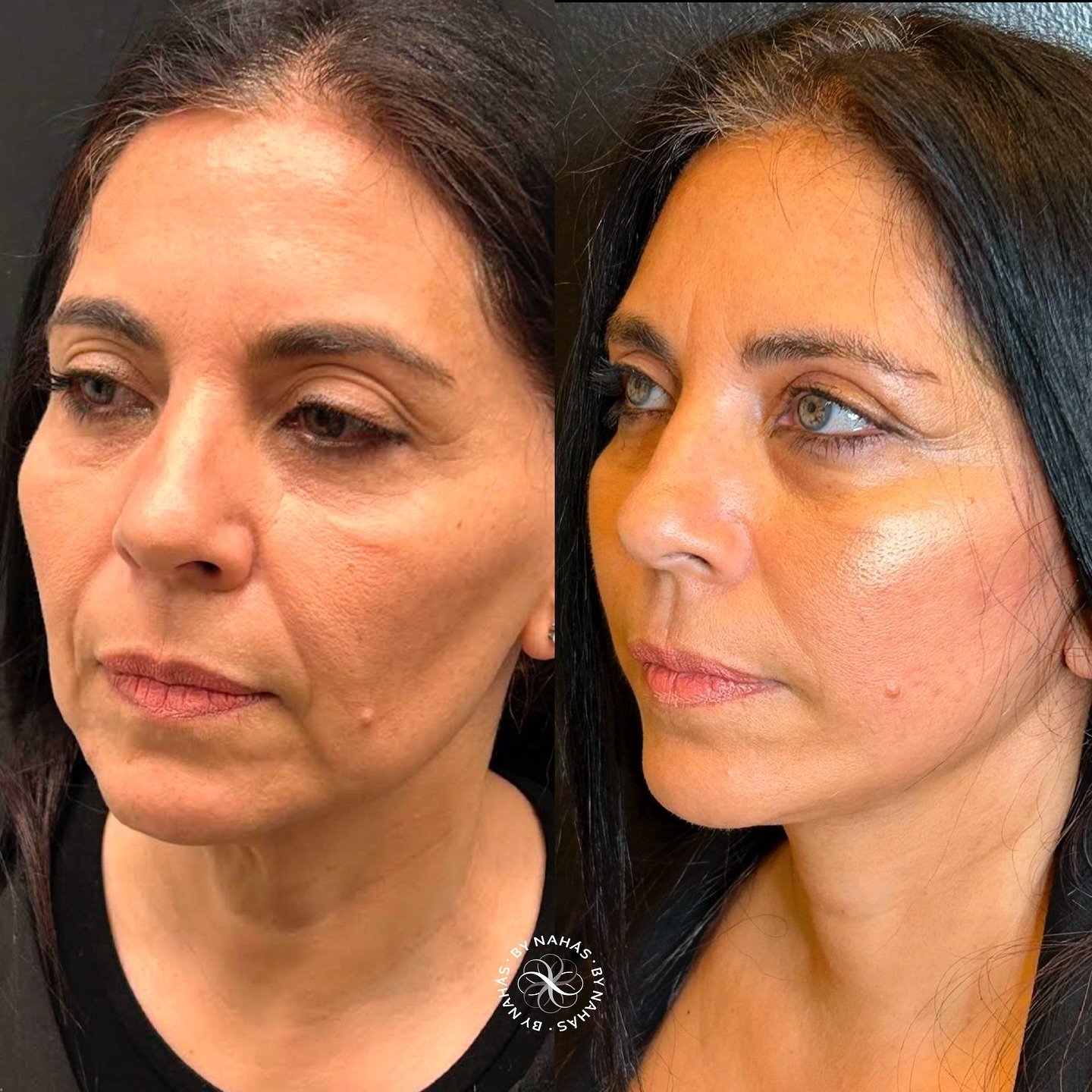 Resultado Paciente 2 - Full Face