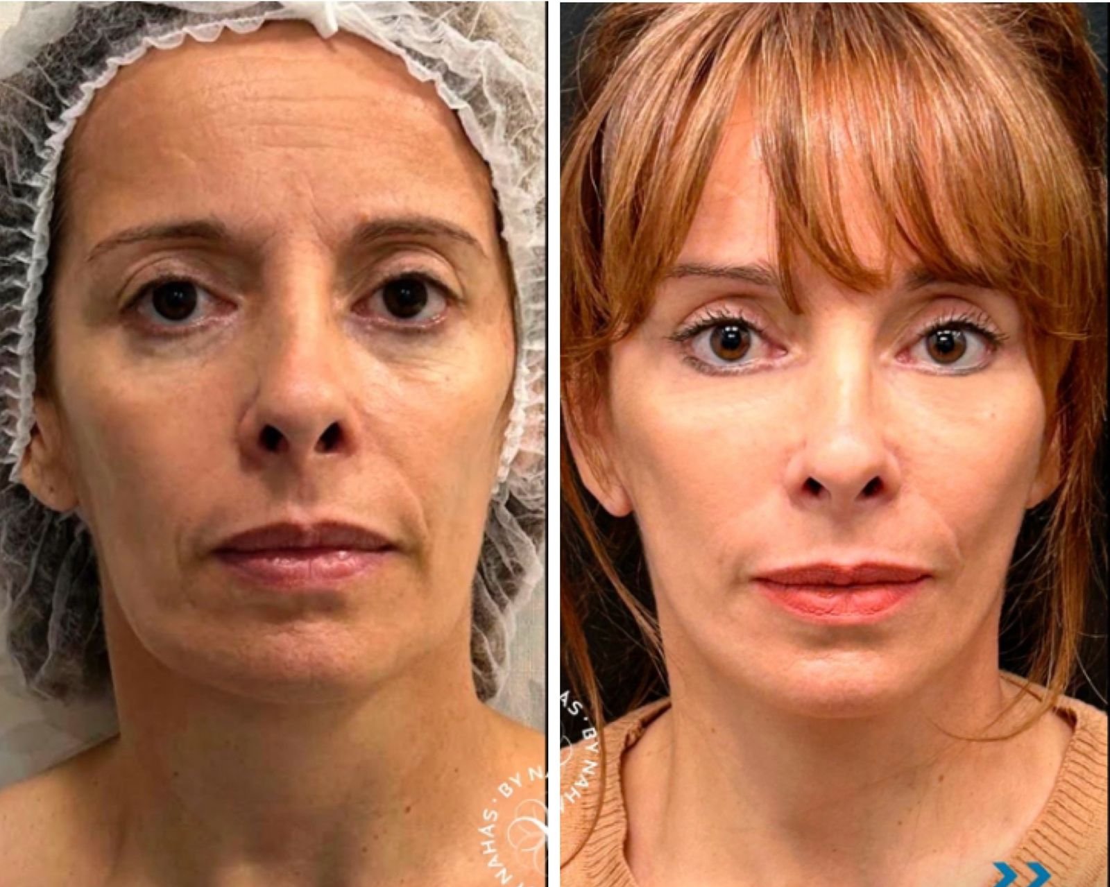 Resultado Paciente 3